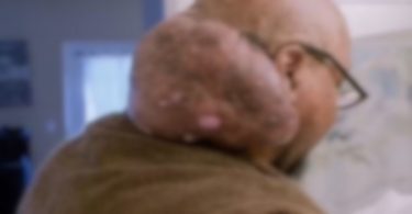 Quem é o homem que conviveu com um tumor do tamanho de um melão no pescoço: ‘Vivi como um monstro’ – Antes e depois impressiona