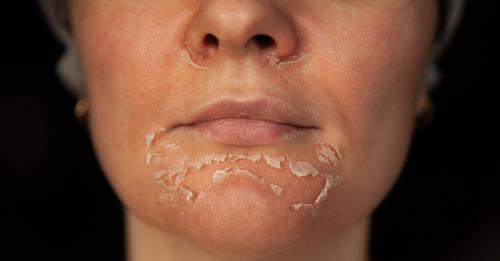 Mulher é internada com queimaduras de terceiro grau após peeling de fenol no PR