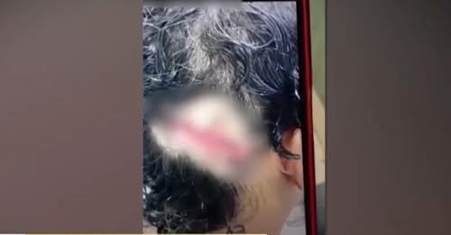 Mulher é torturada e tem ferimento na cabeça colado com cola permanente pelo próprio marido